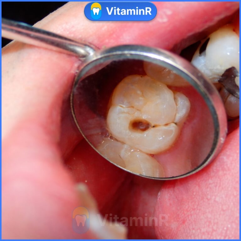 Ca lâm sàng khám răng sâu tại Nha khoa VitaminR