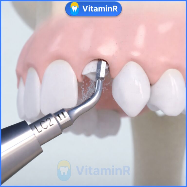 Nhổ răng sâu bằng Piezotome không đau tại Nha khoa VitaminR