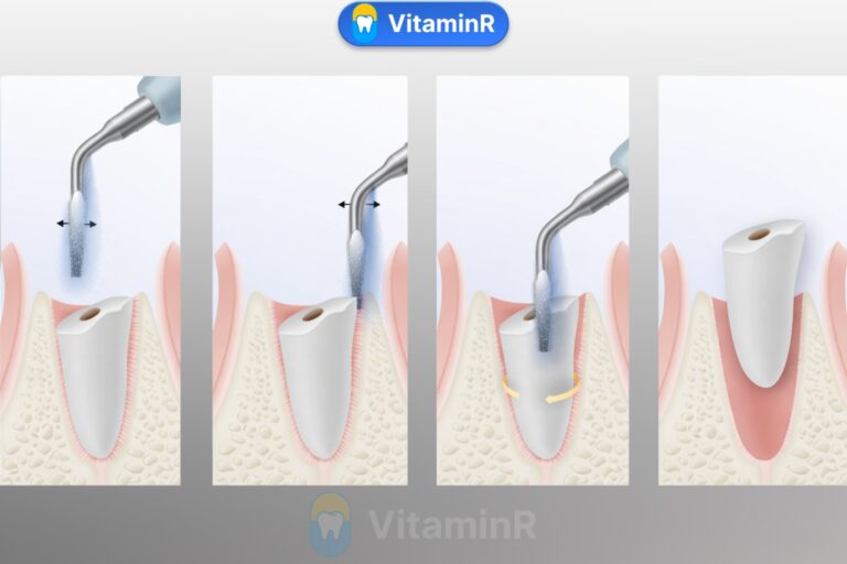 Quy trình nhổ răng sâu bằng Piezotome tại Nha khoa VitaminR