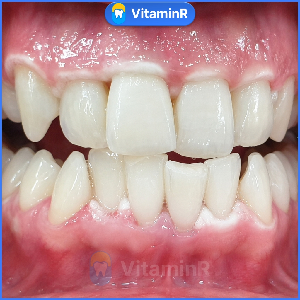 viêm nướu loét miệng có nên tẩy trắng răng không nha khoa vitaminr