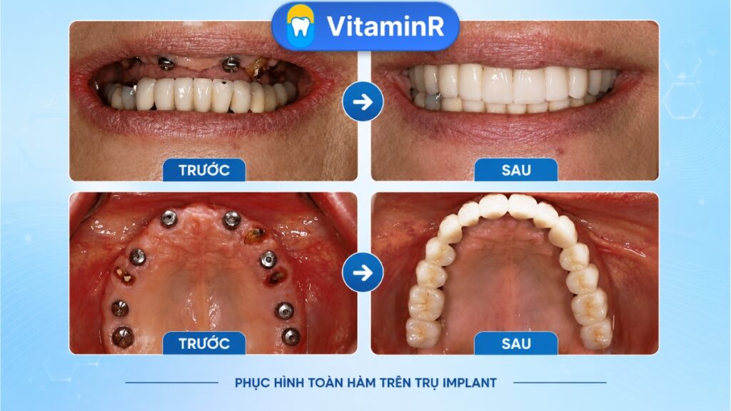 trước và sau phục hình toàn hàm trên trụ Implant tại Nha Khoa VitaminR