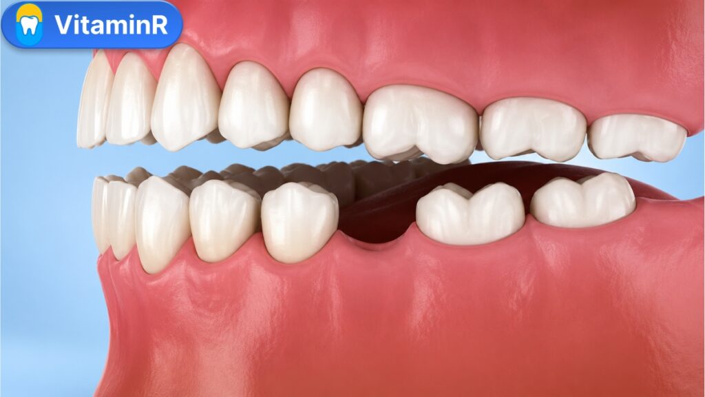 trường hợp mất răng nên trồng răng Implant tại Nha Khoa VitaminR