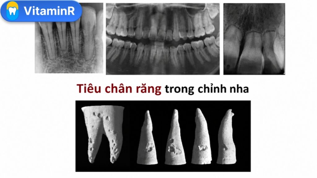 Tiêu chân răng khi niềng trên X-quang và mô phỏng tổn thương bề mặt chân răng