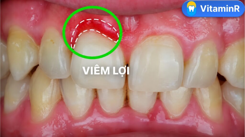 Vùng lợi đỏ quanh một răng phía trước được khoanh tròn, minh họa dấu hiệu bọc răng sứ bị viêm lợi.