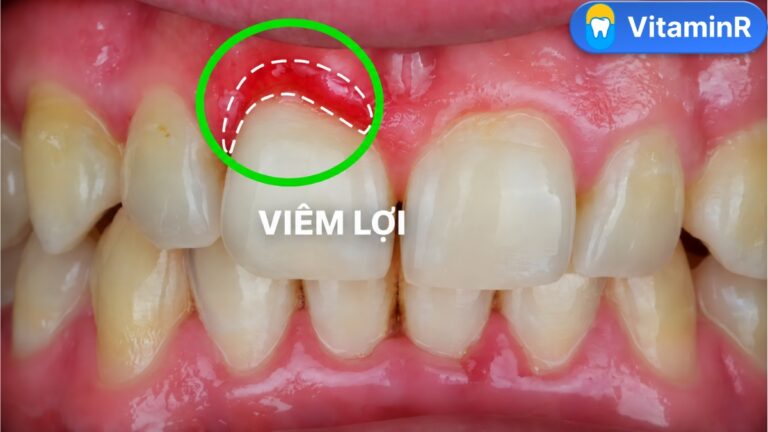 Vùng lợi đỏ quanh một răng phía trước được khoanh tròn, minh họa dấu hiệu bọc răng sứ bị viêm lợi.