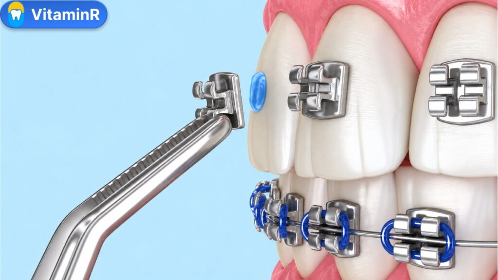 Minh họa dụng cụ đưa mắc cài kim loại đến răng cửa trong quá trình niềng răng