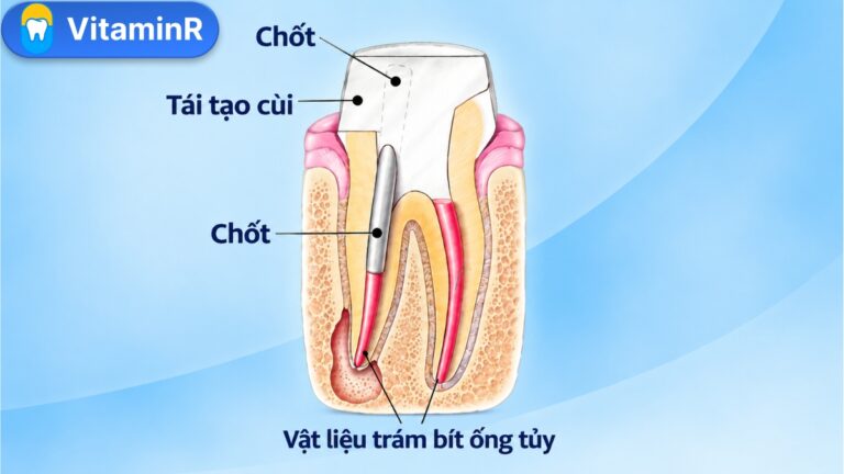 Mặt cắt răng đã điều trị tủy cho thấy cắm chốt răng trong ống tủy, cùi răng tái tạo và vật liệu trám bít còn lại.