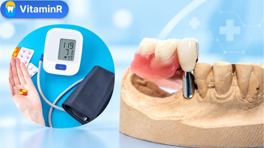 Người cao huyết áp cần kiểm tra huyết áp trước khi trồng Implant