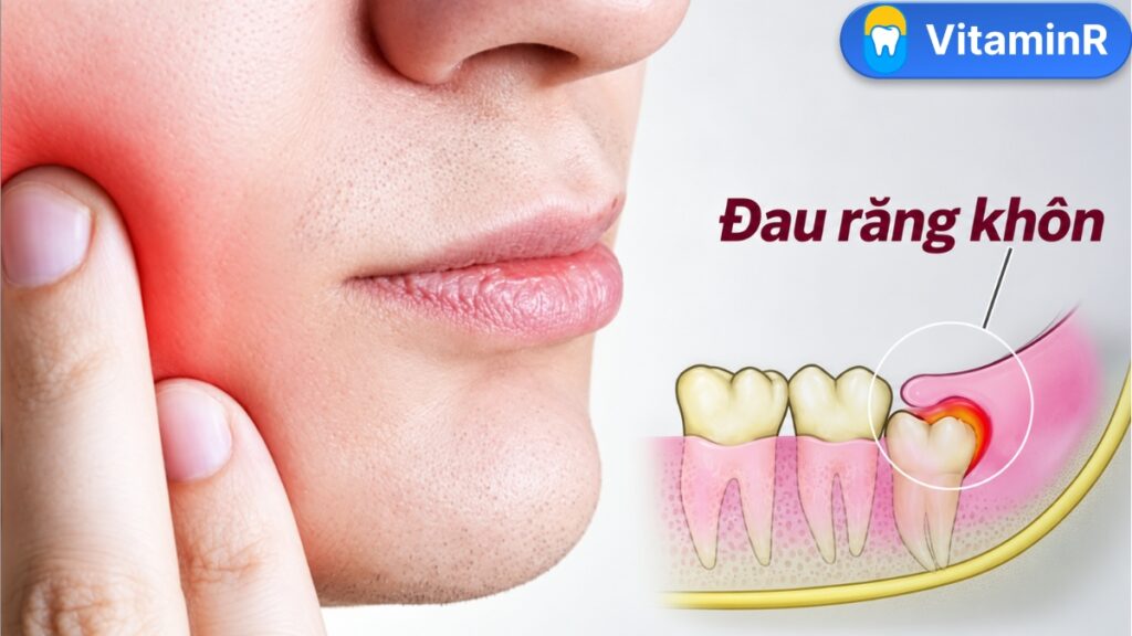 Đau răng khôn do răng số 8 mọc một phần gây viêm lợi trùm