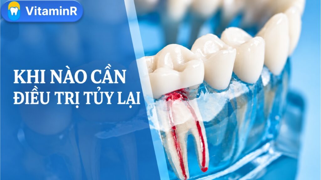 Minh họa răng với dòng chữ “Khi nào cần điều trị tủy lại” của Nha khoa VitaminR