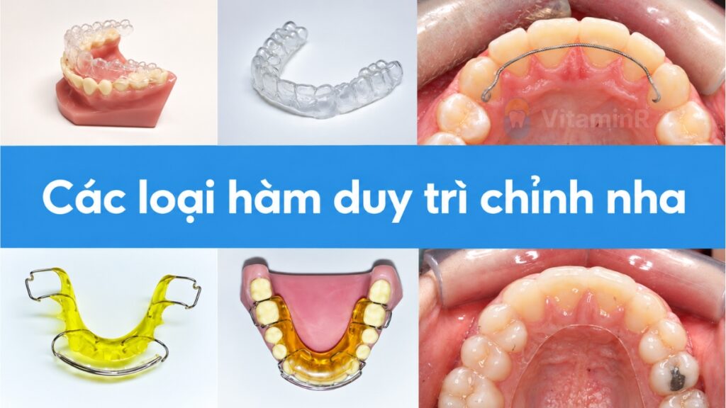 Các loại hàm duy trì giúp ổn định răng sau tháo niềng tại VitaminR