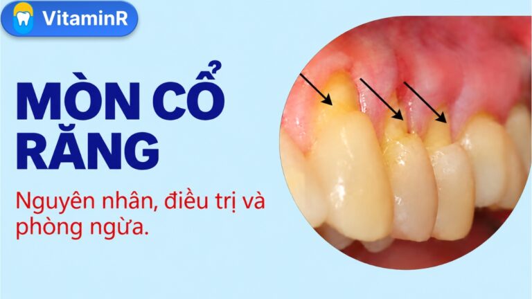 Vùng cổ răng sát nướu được đánh dấu trong ảnh minh họa bài mòn cổ răng của VitaminR