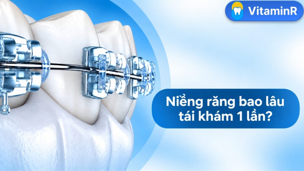 Niềng răng bao lâu tái khám 1 lần tại Nha khoa VitaminR