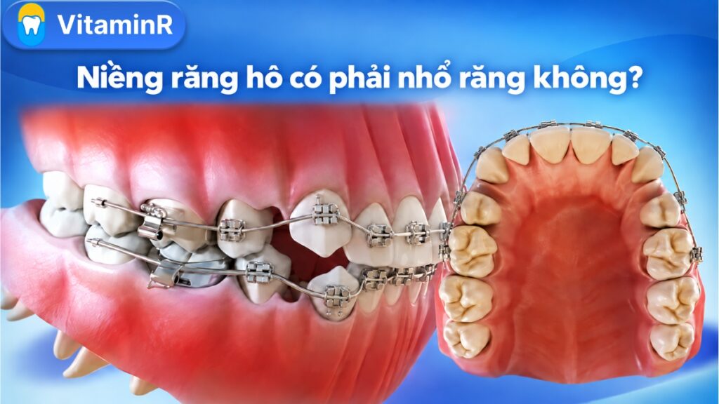Niềng răng hô có phải nhổ răng không?