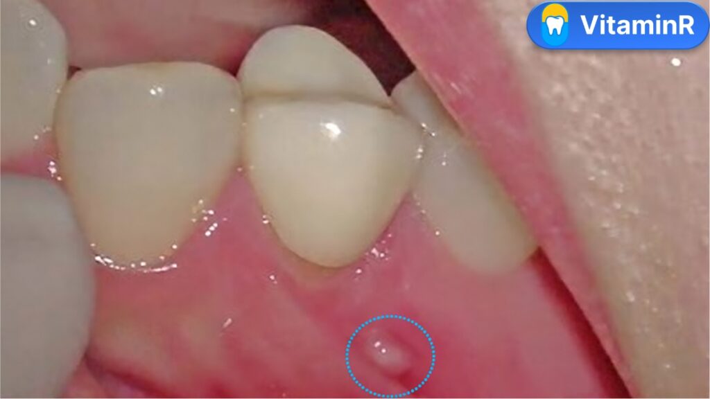 Nốt sưng trên nướu được khoanh tròn, dấu hiệu cần khám trước khi cân nhắc điều trị tủy lại