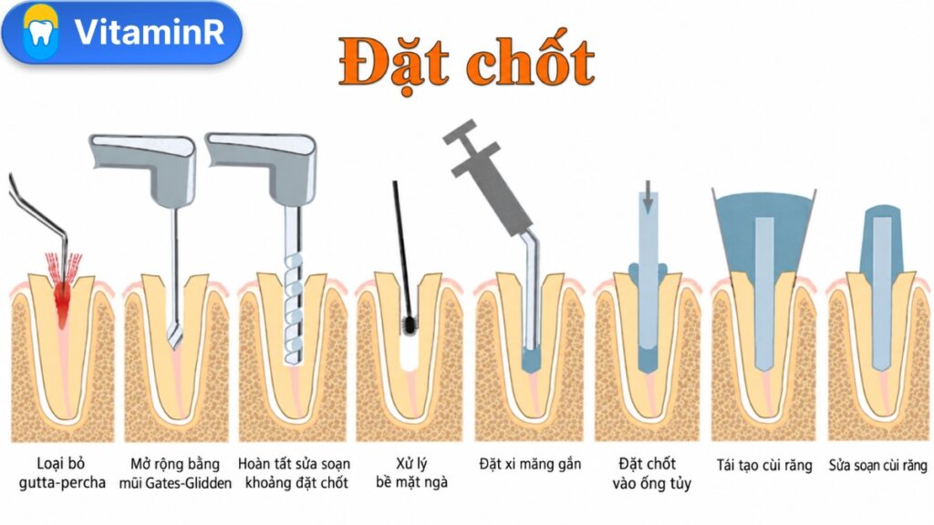 Sơ đồ chuẩn bị khoảng đặt chốt trong ống tủy, gắn chốt và tái tạo cùi răng.