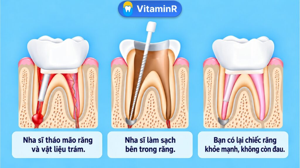 Sơ đồ quy trình điều trị tủy lại gồm tiếp cận ống tủy, làm sạch và phục hồi răng