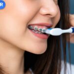 Cách vệ sinh răng miệng khi niềng bằng bàn chải quanh mắc cài, ảnh minh họa VitaminR.