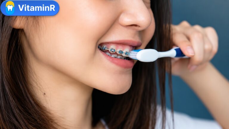 Cách vệ sinh răng miệng khi niềng bằng bàn chải quanh mắc cài, ảnh minh họa VitaminR.