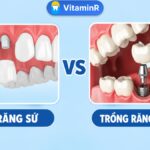 Cầu răng sứ hay Implant: minh họa hai phương pháp phục hồi răng mất, có logo Nha khoa VitaminR.