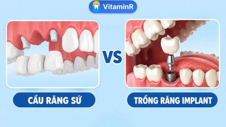 Cầu răng sứ hay Implant: minh họa hai phương pháp phục hồi răng mất, có logo Nha khoa VitaminR.