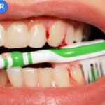 Chảy máu chân răng khi đánh răng bằng bàn chải màu xanh lá