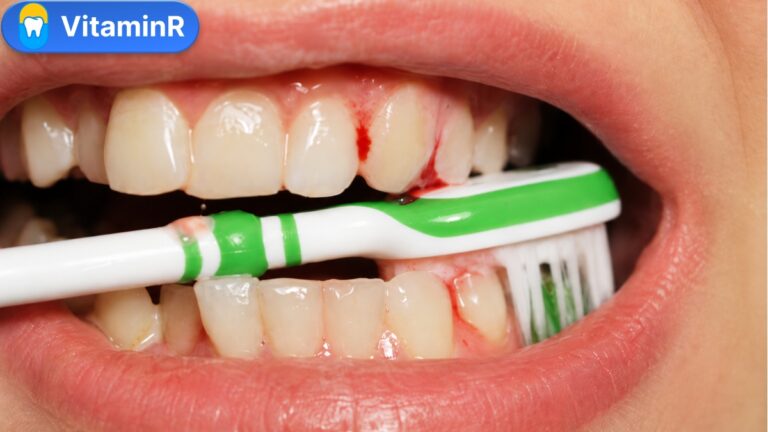 Chảy máu chân răng khi đánh răng bằng bàn chải màu xanh lá
