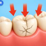 Răng hàm bị nứt dưới lực tác động, minh họa bài nghiến răng có bọc răng sứ hoặc dán veneer được không của VitaminR.