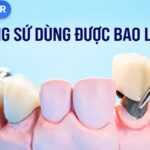 Mô hình mão sứ trên răng thật với tiêu đề Răng sứ dùng được bao lâu và logo VitaminR