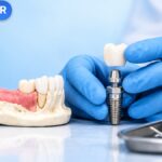 Mô hình xương hàm, trụ Implant và mão răng minh họa bài sau nhổ răng bao lâu thì trồng Implant của VitaminR.