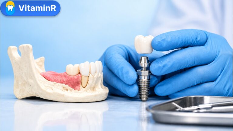 Mô hình xương hàm, trụ Implant và mão răng minh họa bài sau nhổ răng bao lâu thì trồng Implant của VitaminR.