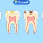 Minh họa sâu răng tiến triển từ men vào ngà răng – VitaminR